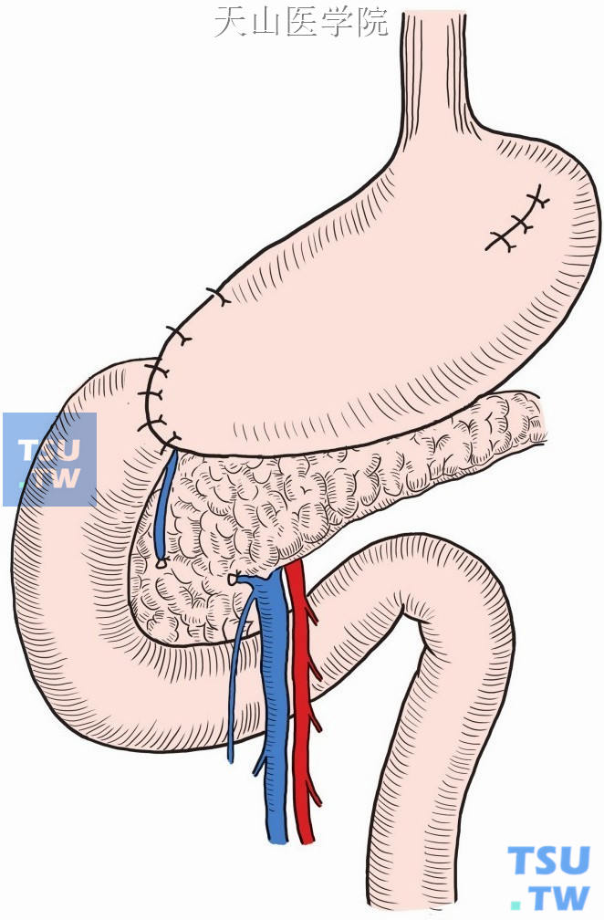 远端胃切除后行胃空肠吻合