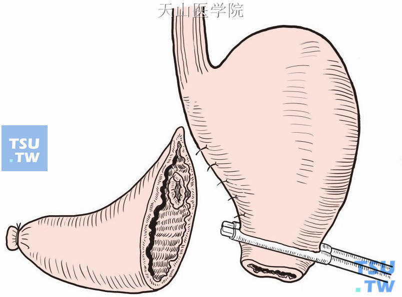 切除远端胃及溃疡所在胃壁