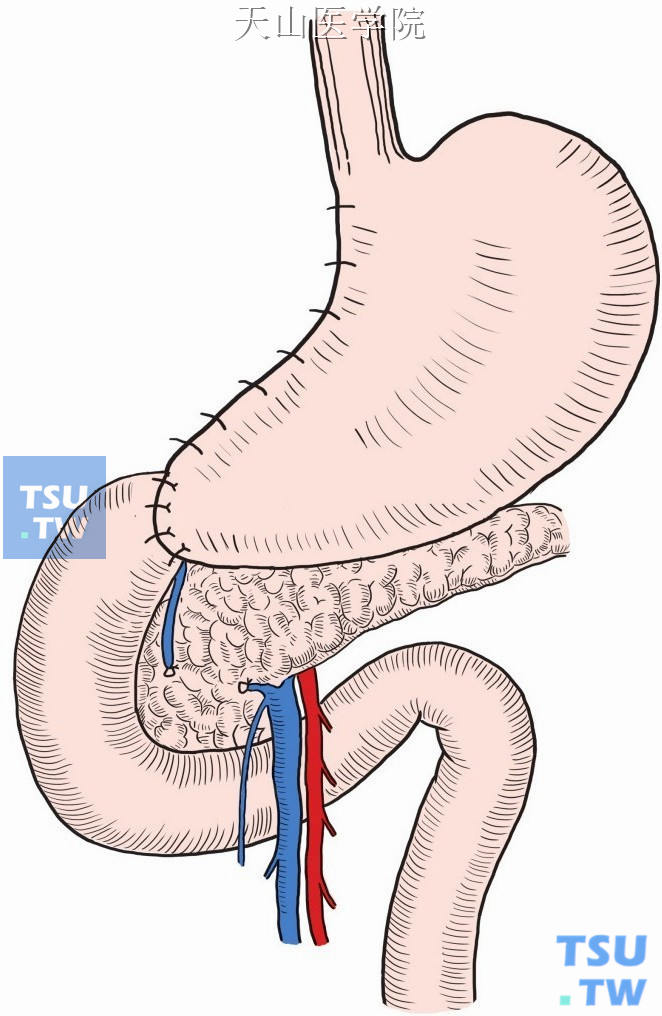 胃十二指肠端端吻合