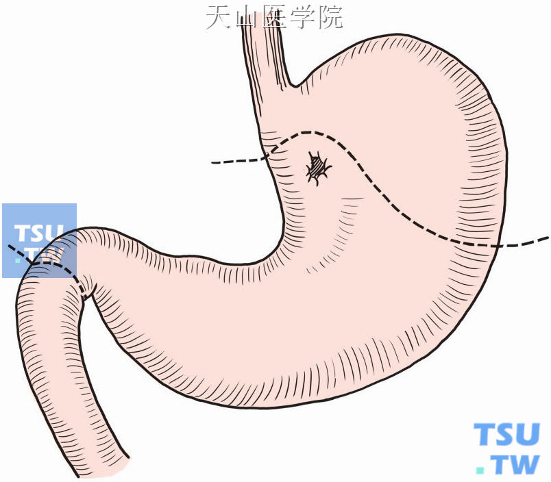 远侧及溃疡所在胃组织切除