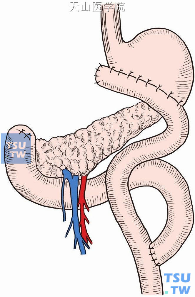 食管空肠吻合术示意图图片