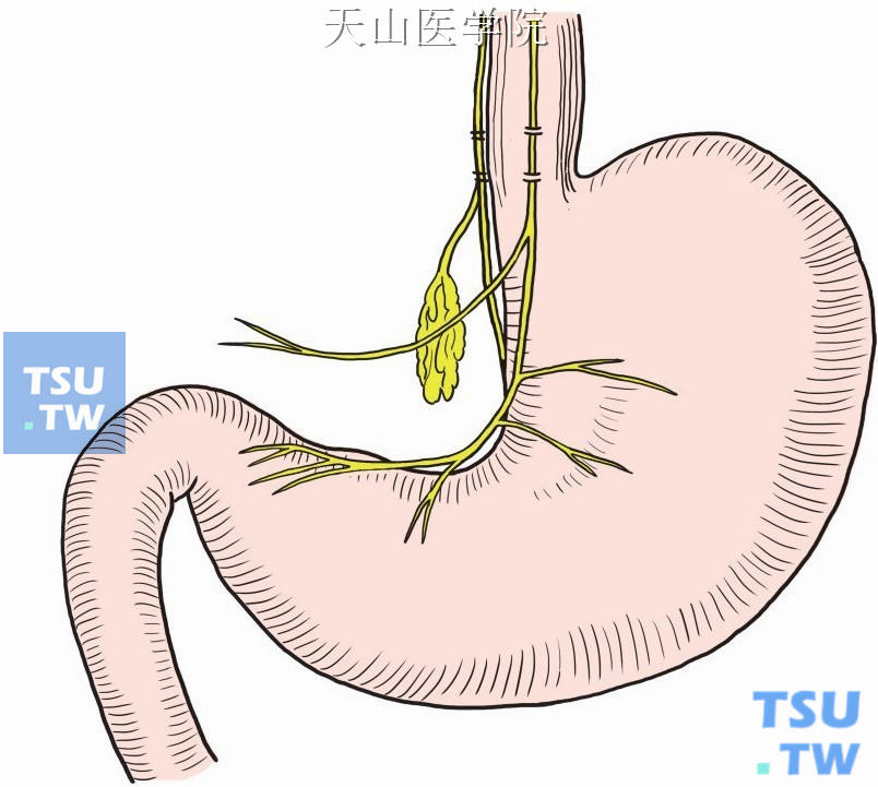 迷走神经切断处