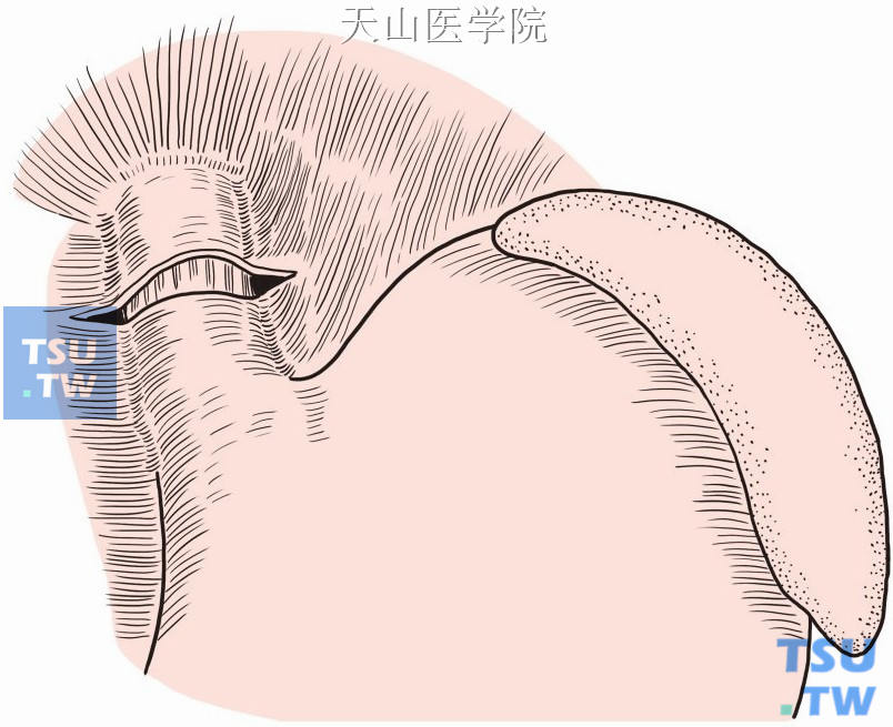 横向剪开贲门食管前腹膜