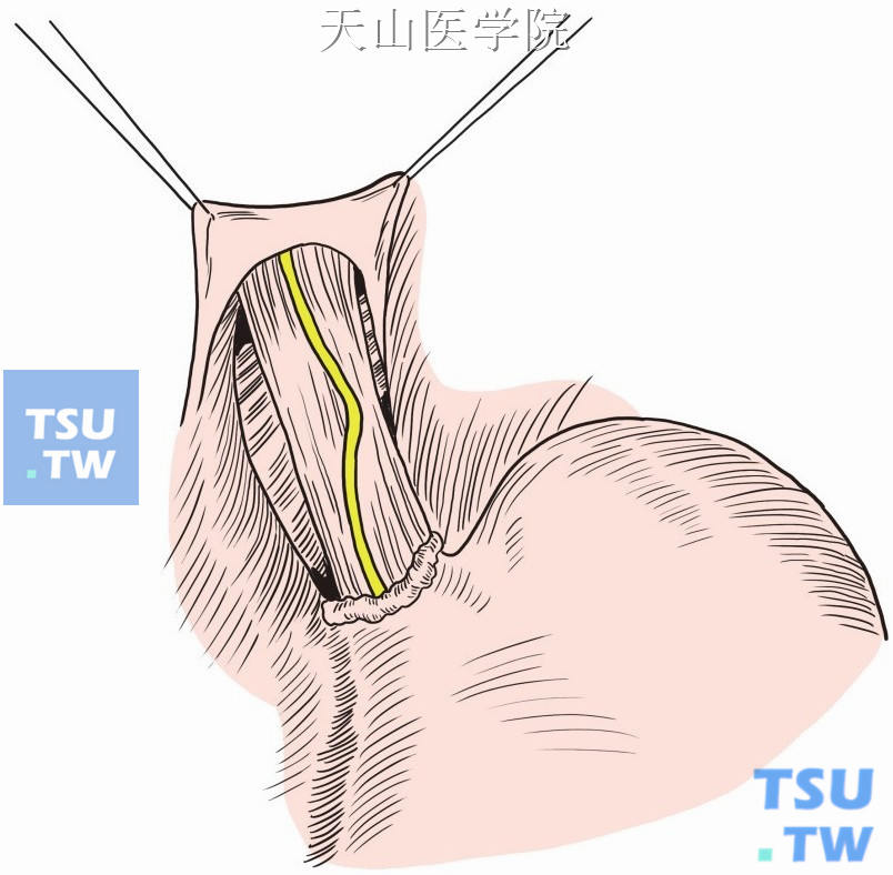 迷走神经干切断术图片