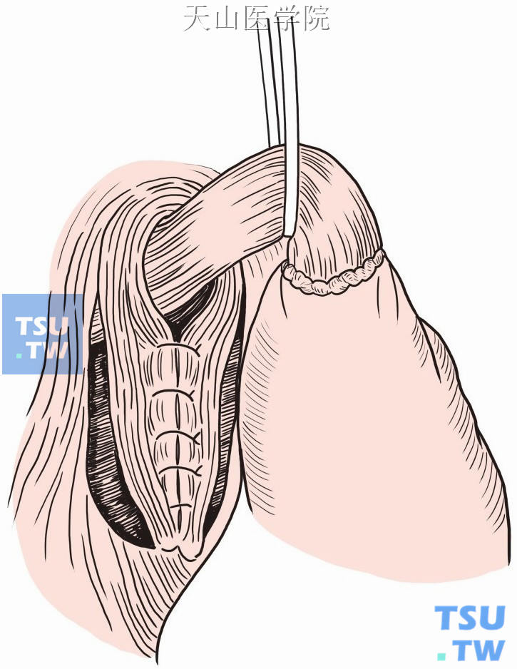 缝合食管裂孔
