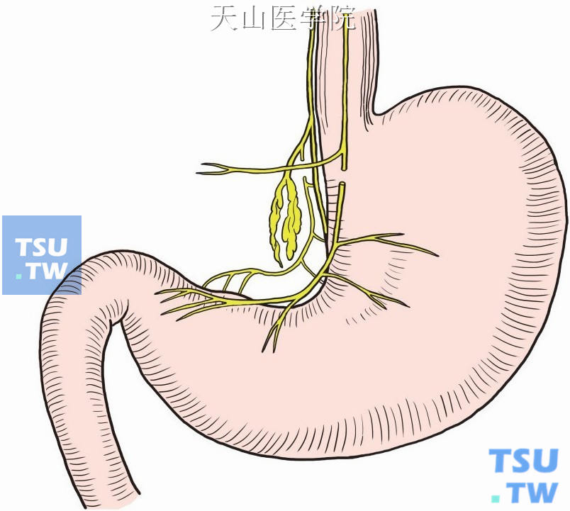 选择性迷走神经切断处