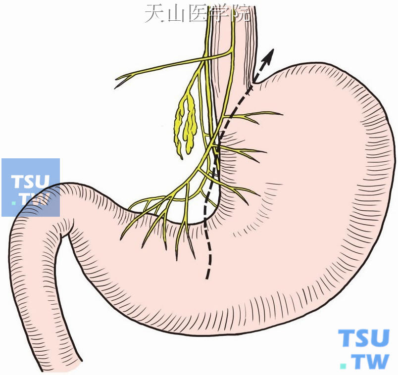 高选择性迷走神经切断术