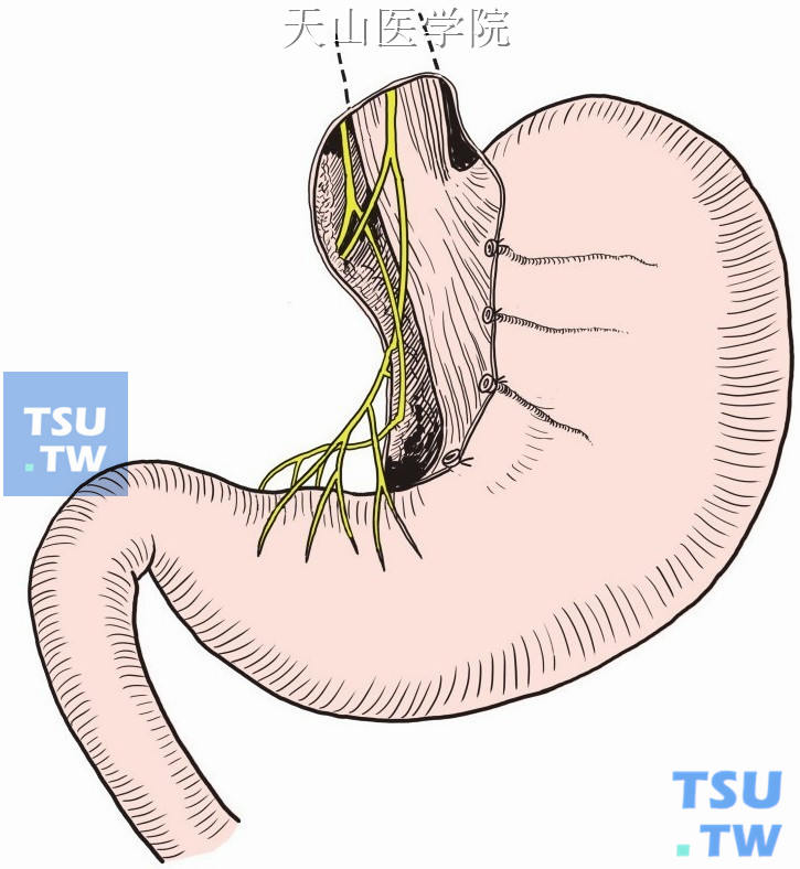 游离迷走神经前后干并离断胃壁分支