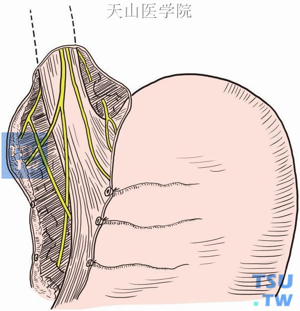 迷走神经干切断术图片