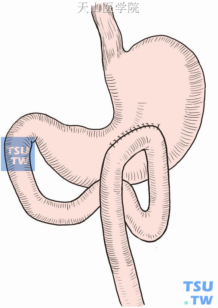 胃空肠吻合术