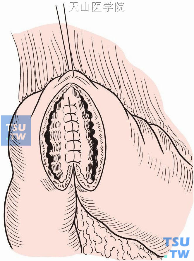 连续全层缝合后壁