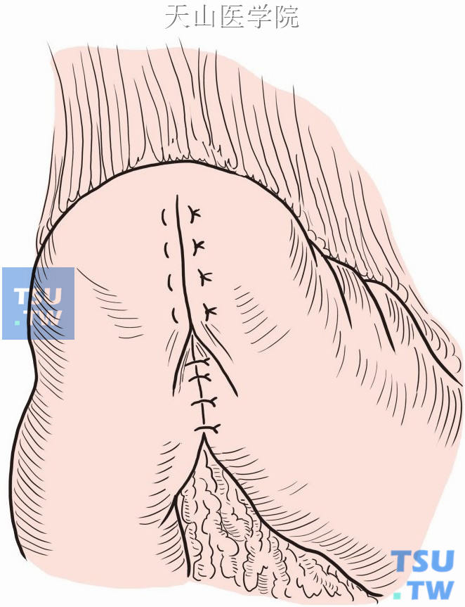 前壁做Connell式内翻缝合，再间断浆肌层缝合