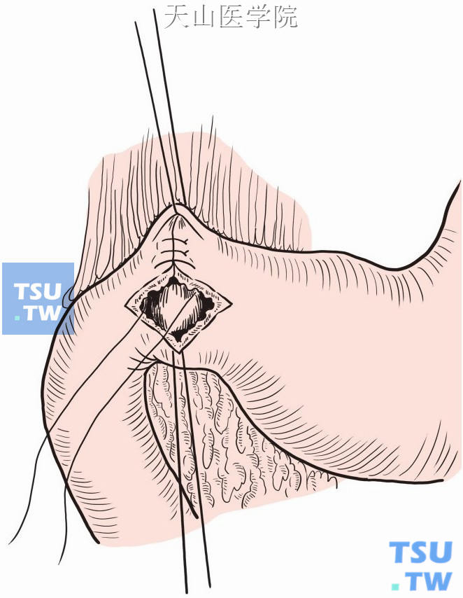 沿胃纵轴垂直方向用2-0可吸收线全层间断内翻缝合该切口