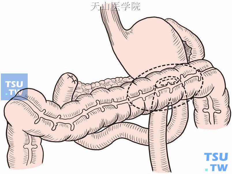 瘘口及其周围消化管切除范围