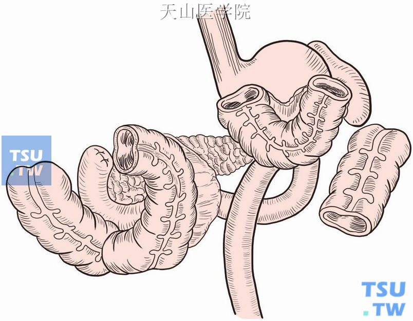 切断横结肠及其相应系膜