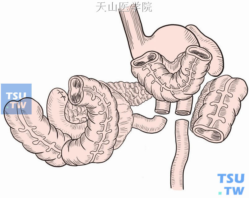 切断近瘘口处近、远端空肠