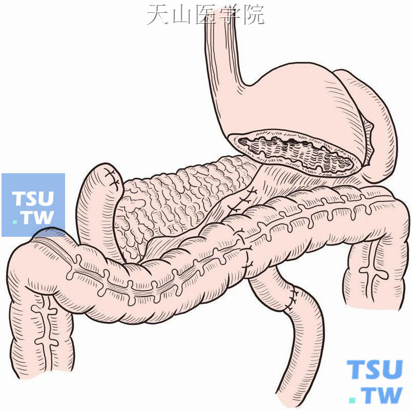 吻合横结肠及空肠