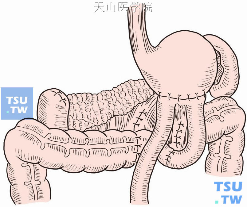 胃术后胃空肠结肠瘘彻底性一期切除术