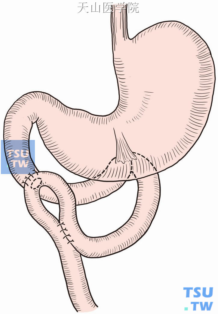 空肠襻式浆膜覆盖术