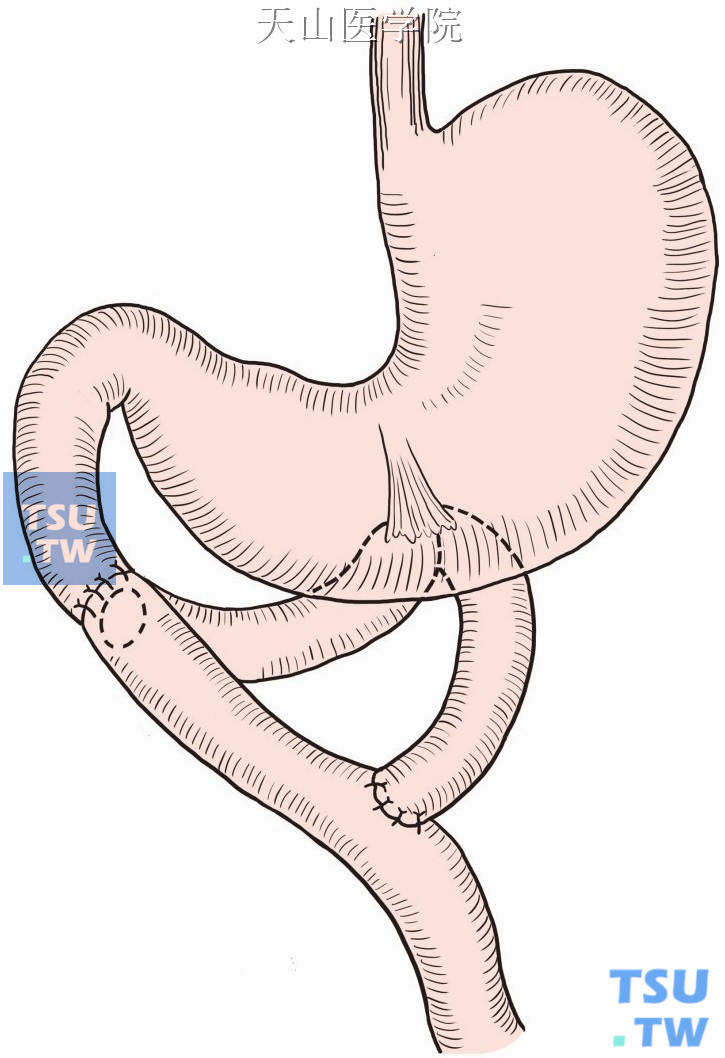 空肠“Y”形吻合覆盖术