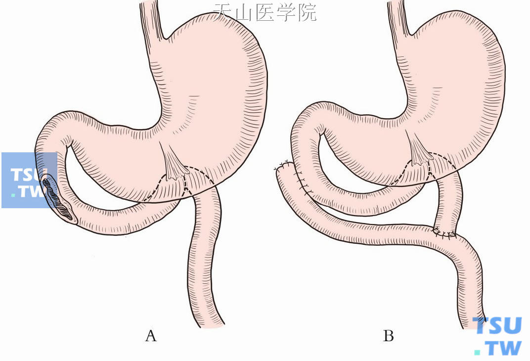 空肠“Y”形肠襻与十二指肠缺损部吻合