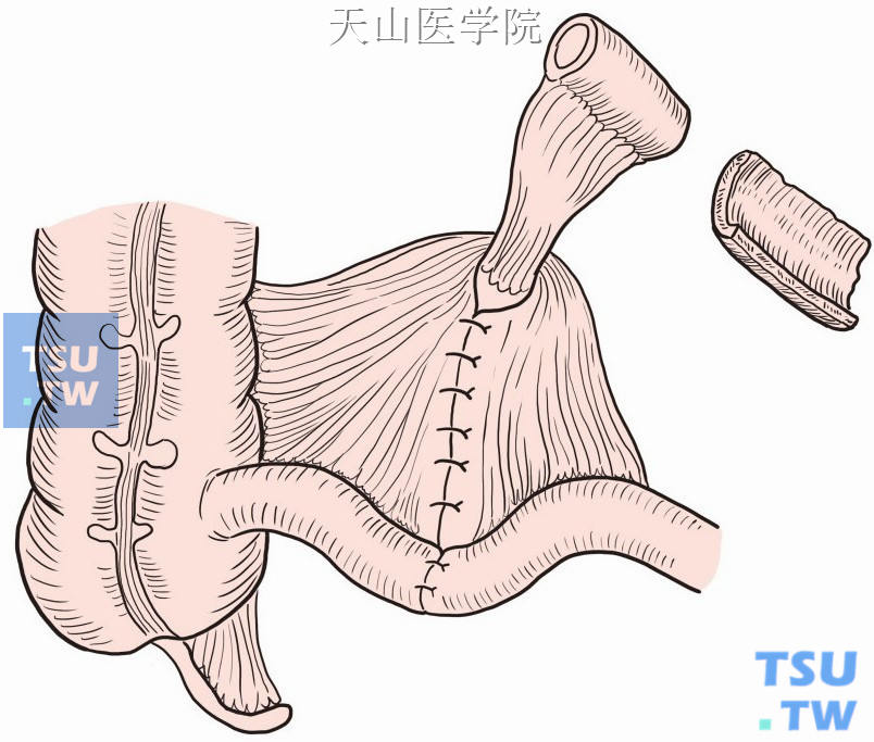 制备回肠带蒂浆肌层片