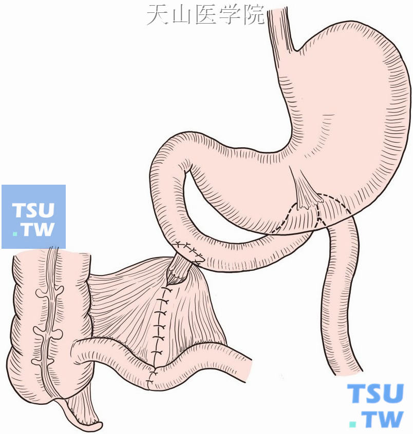 用回肠浆肌层片修补或加固十二指肠缺损