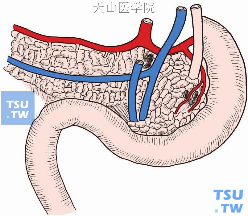 探查胰头后淋巴结