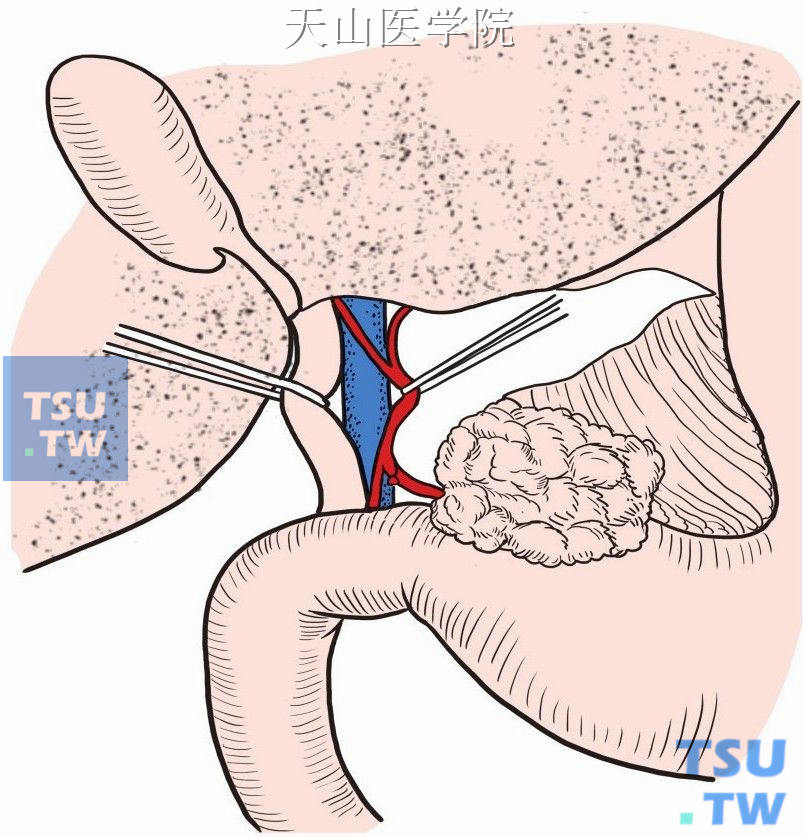 胃右动脉根部离断