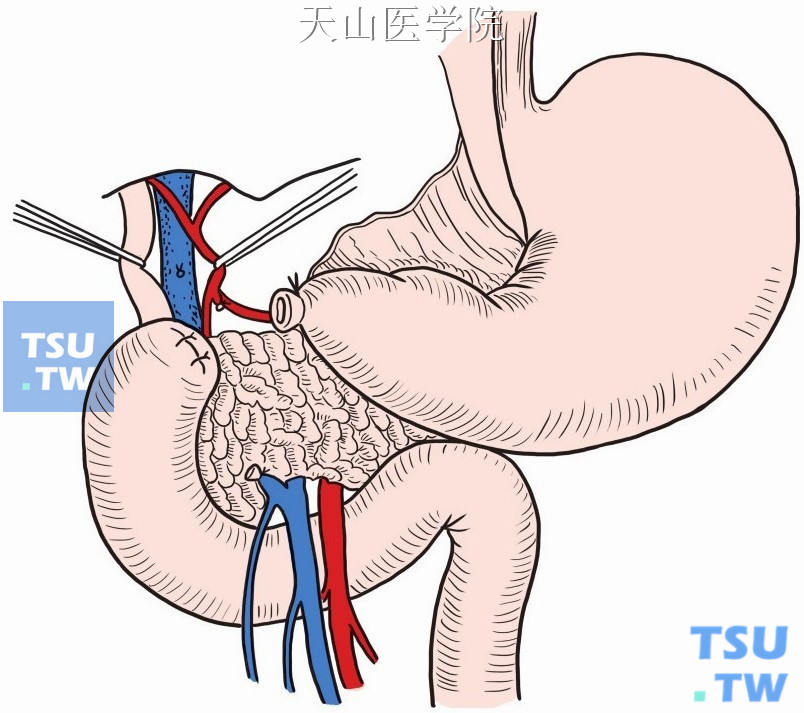 切断十二指肠