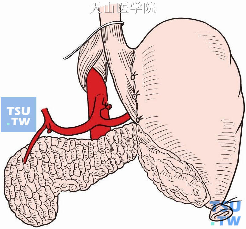 清扫胃小弯上部淋巴结