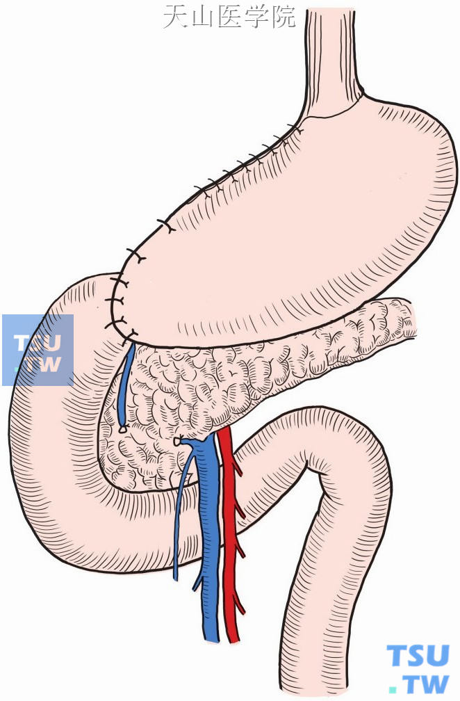 胃远端大部切除毕二式图片