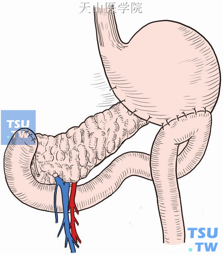 胃远端大部切除毕二式图片