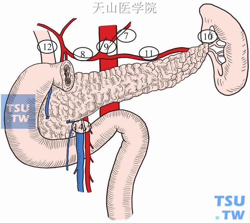 胃癌根治性全胃切除术