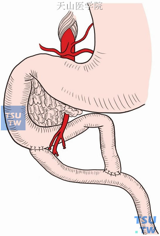 十二指肠空肠Roux-en-Y吻合术