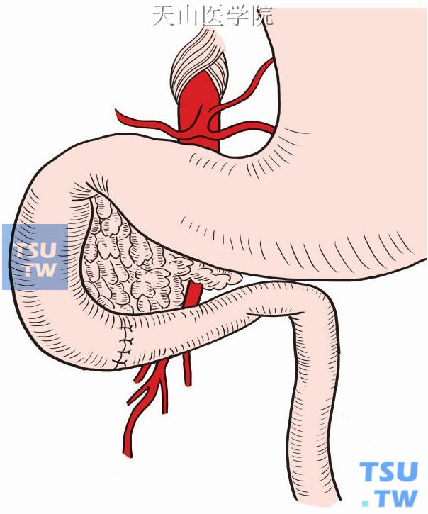 肠系膜上动脉综合征解除术