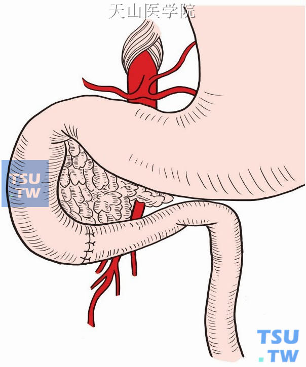 十二指肠血管前移位术