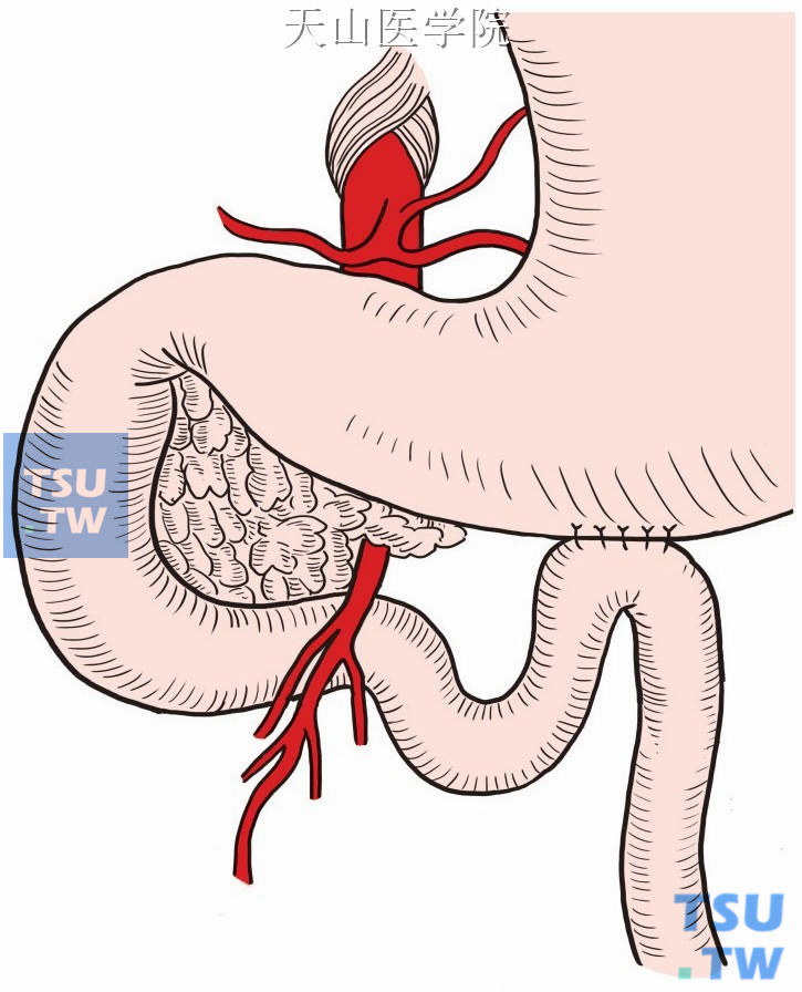 胃空肠吻合术示意图图片