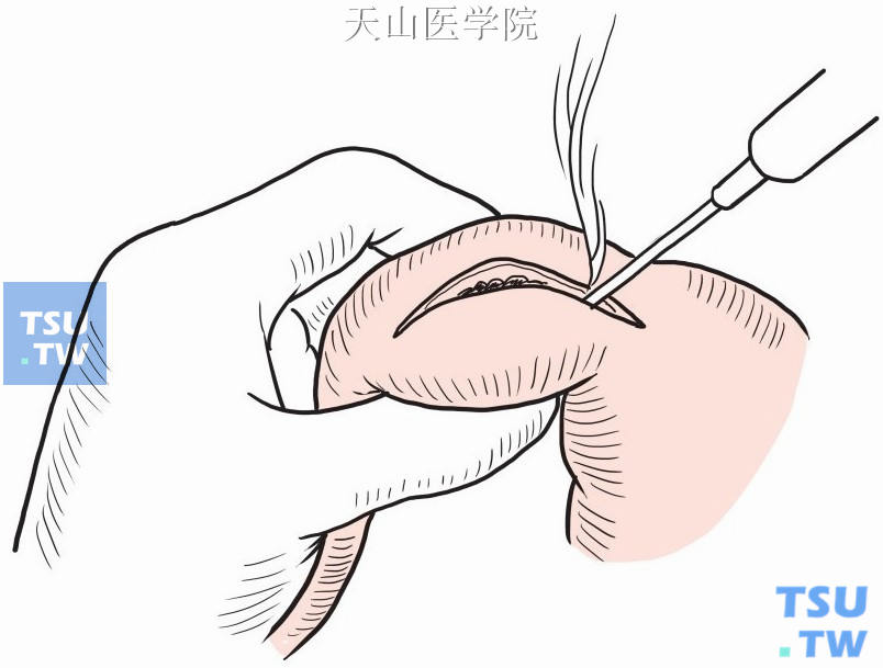 切开肥厚的幽门括约肌