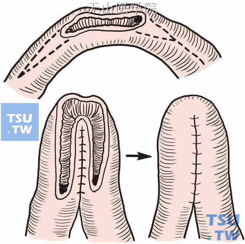 小肠破口“V”形缝合