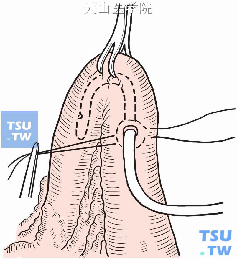 回肠双腔造瘘术图片
