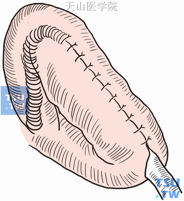 小肠插管隧道式包埋