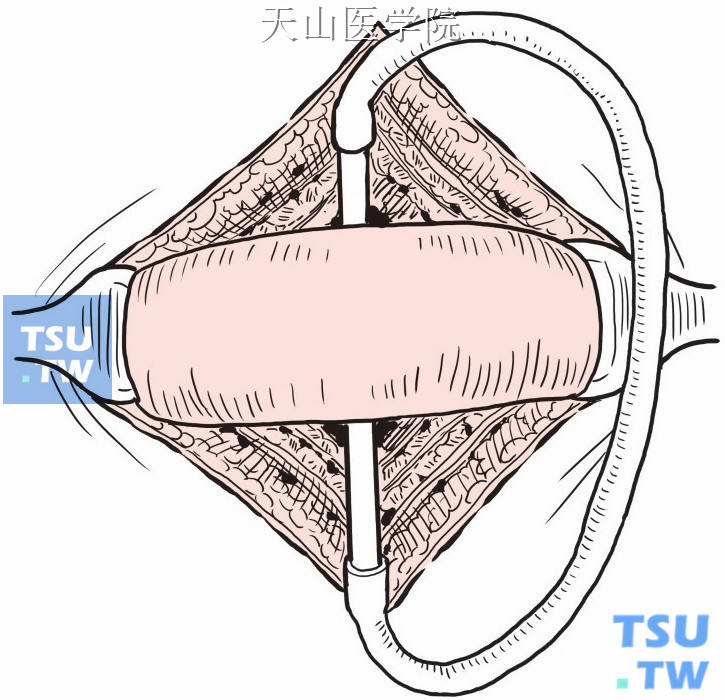 小肠造口术示意图图片