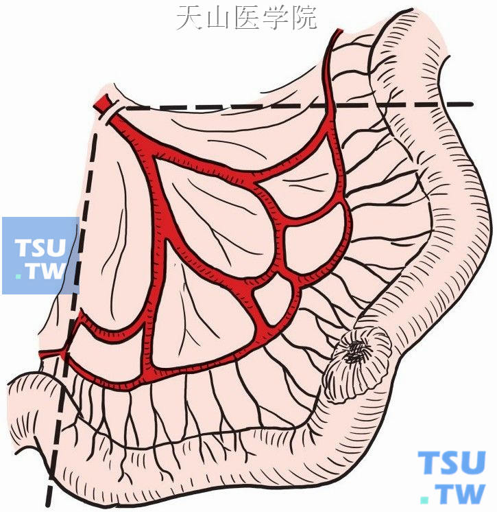 小肠肿瘤切除小肠吻合术