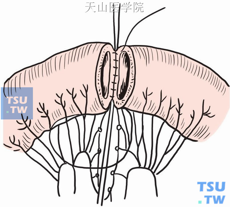 后壁全层间断缝合