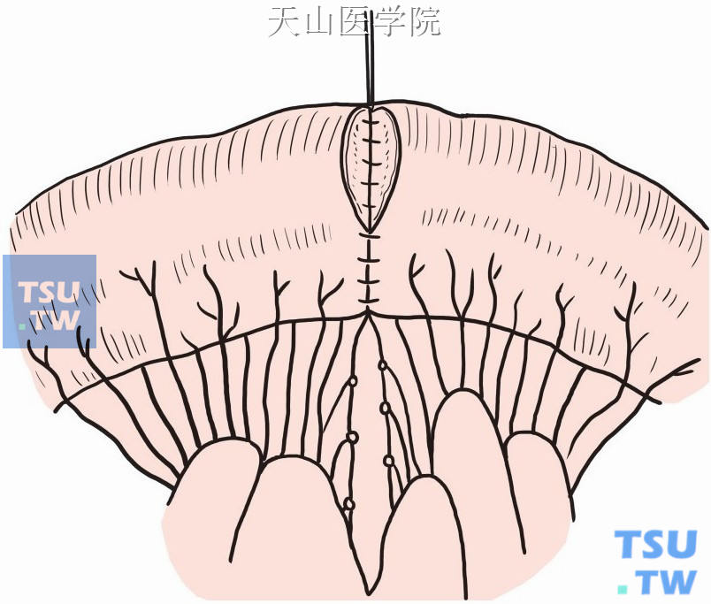 浆肌层间断缝合