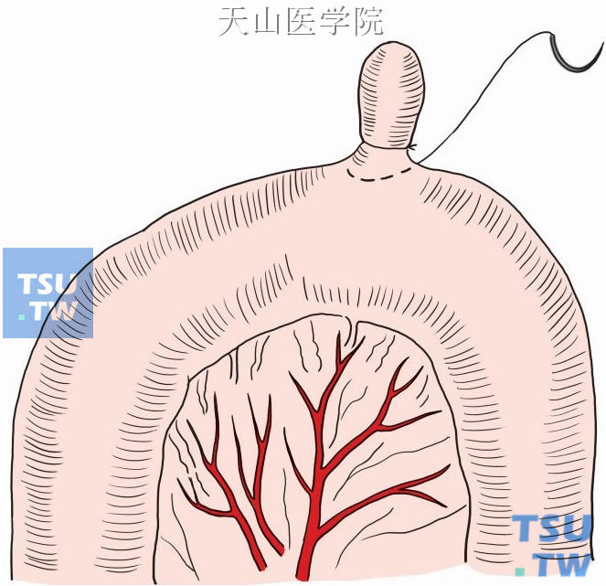 美克尔憩室图片