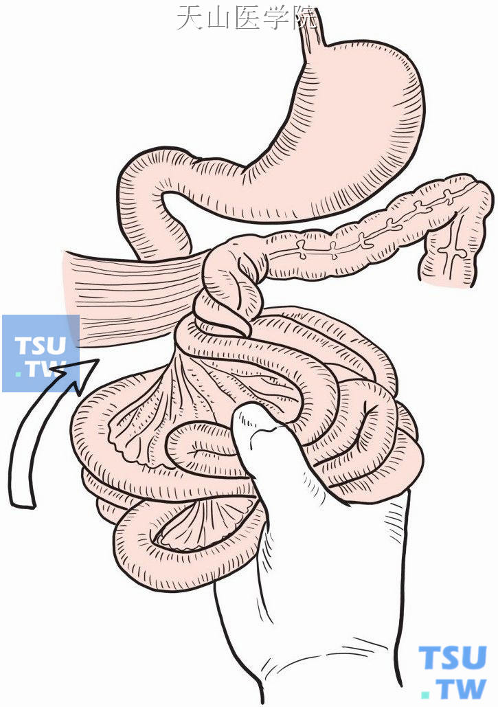 先天性中肠回转不全致肠扭转