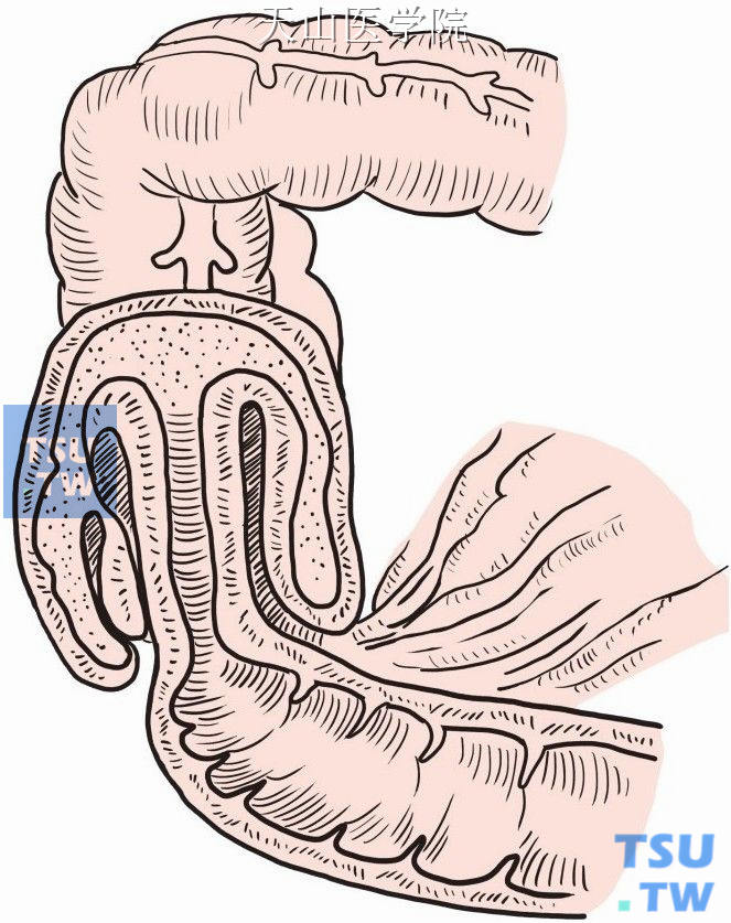 回结肠套叠