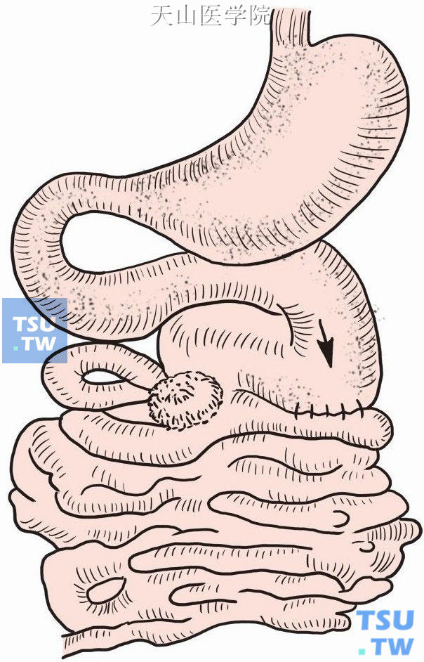 近端扩张肠管与远端空瘪肠管吻合
